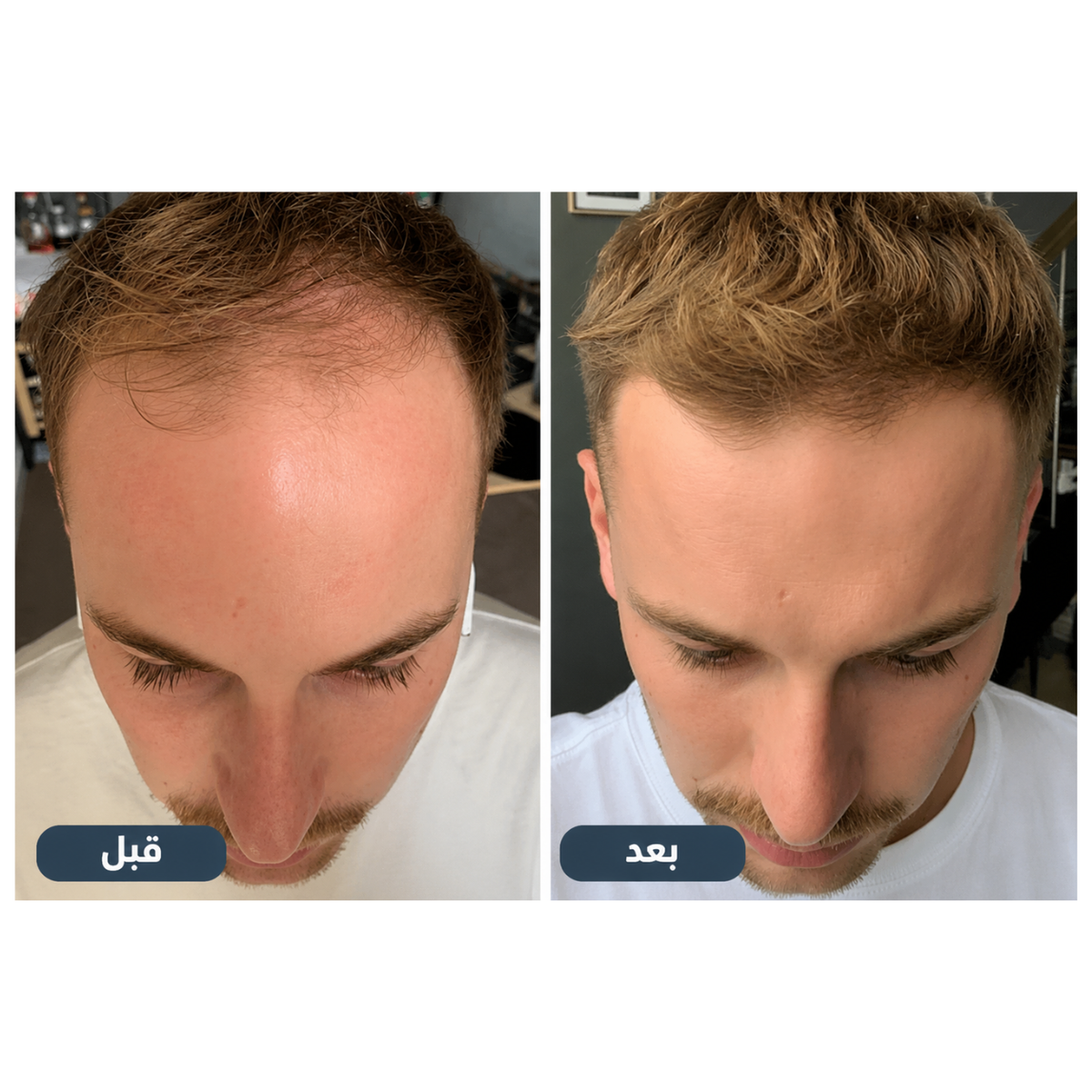 Member's Mark 5 % Minoxidil Liquide 1 Mois